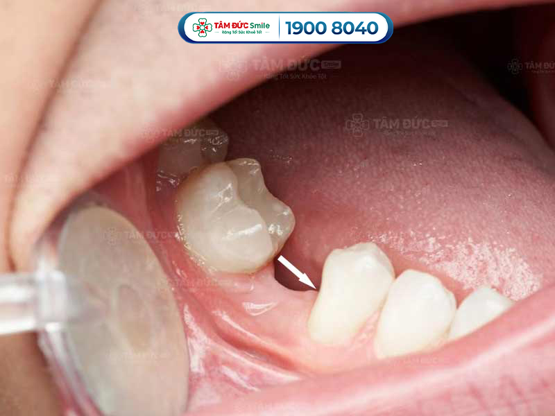 mất răng vĩnh viễn làm xô lệch răng kế cận