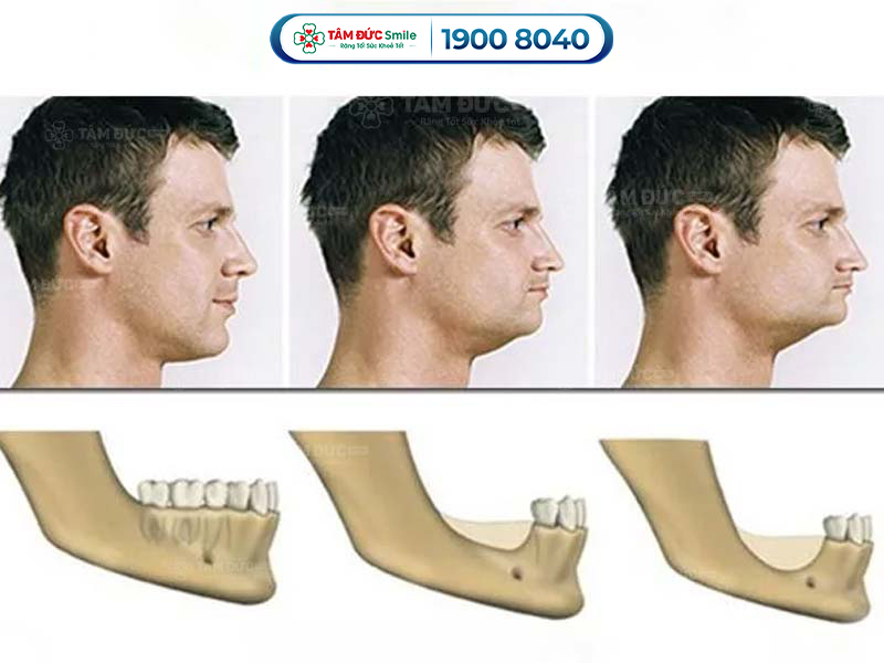 gương mặt lão hoá nhanh hơn sau khi mất răng vĩnh viễn