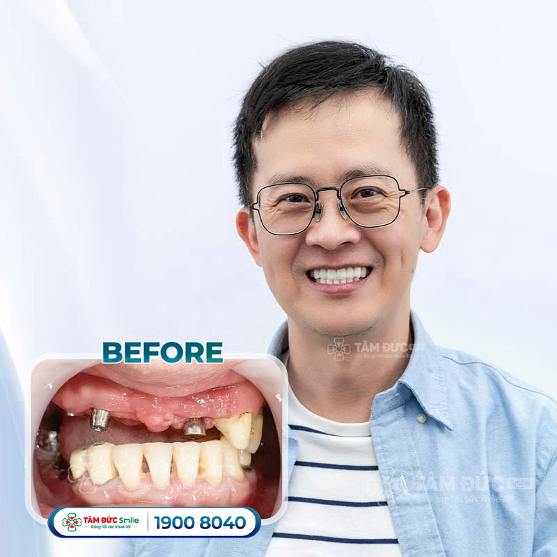 khách hàng cấy ghép Implant tại nha khoa Tâm Đức Smile