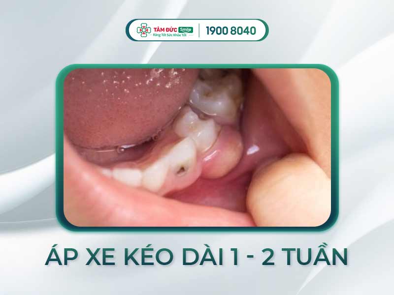 ÁP XE RĂNG BAO LÂU THÌ KHỎI? CÁCH PHÒNG NGỪA ÁP XE RĂNG