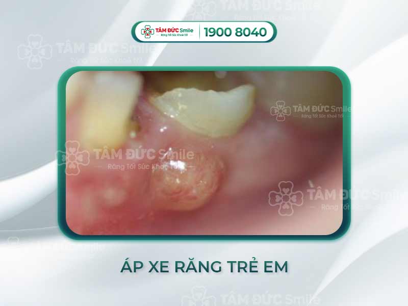 ÁP XE RĂNG Ở TRẺ EM CÓ NGUY HIỂM KHÔNG? CÁCH TRỊ DỨT ĐIỂM VÀ PHÒNG NGỪA
