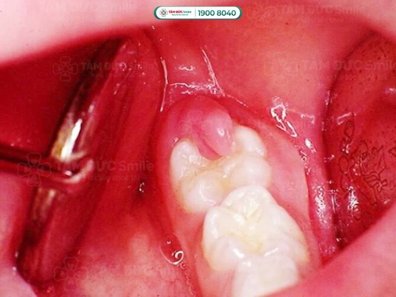 áp xe răng số 7 phải làm sao