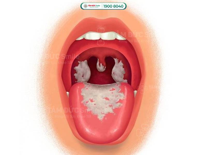 bạch hầu là bệnh gì? Bệnh bạch hầu có chữa được không