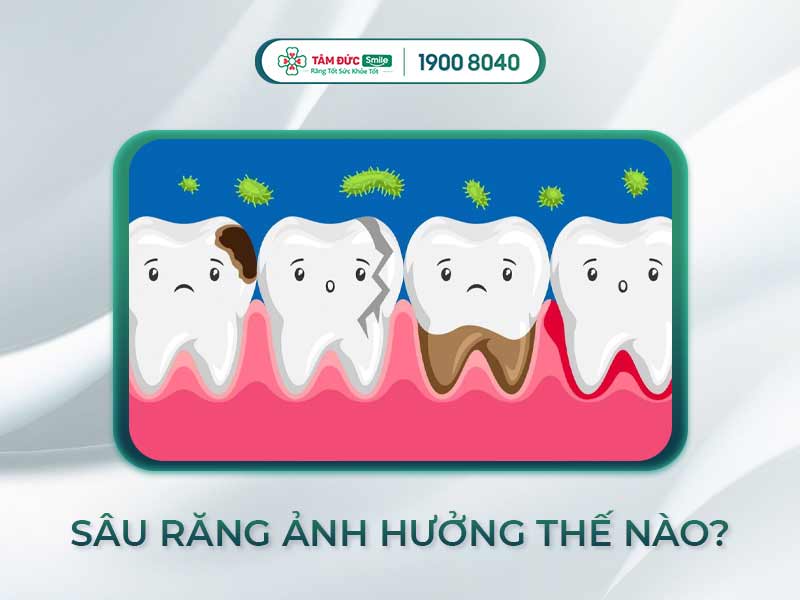 BỆNH SÂU RĂNG CÓ LÂY KHÔNG? 10 CÁCH PHÒNG LÂY NHIỄM SÂU RĂNG TỪ NGƯỜI KHÁC