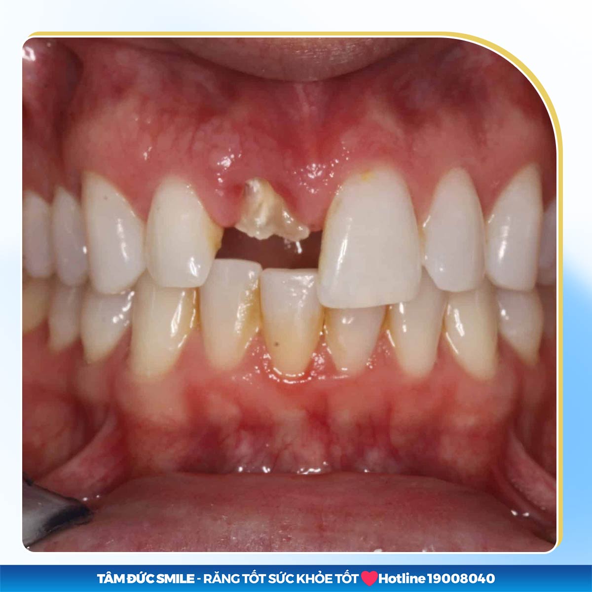 BỊ GÃY RĂNG CỬA: CÁCH KHẮC PHỤC HIỆU QUẢ, THẨM MỸ CAO