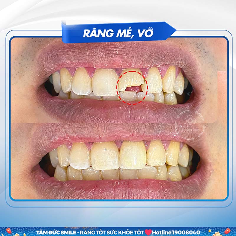 bị gãy răng cửa và cách khắc phục