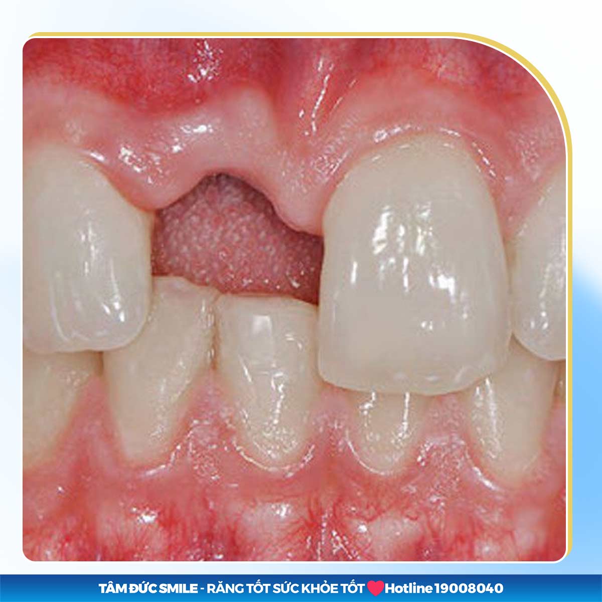 cách chữa mất răng cửa