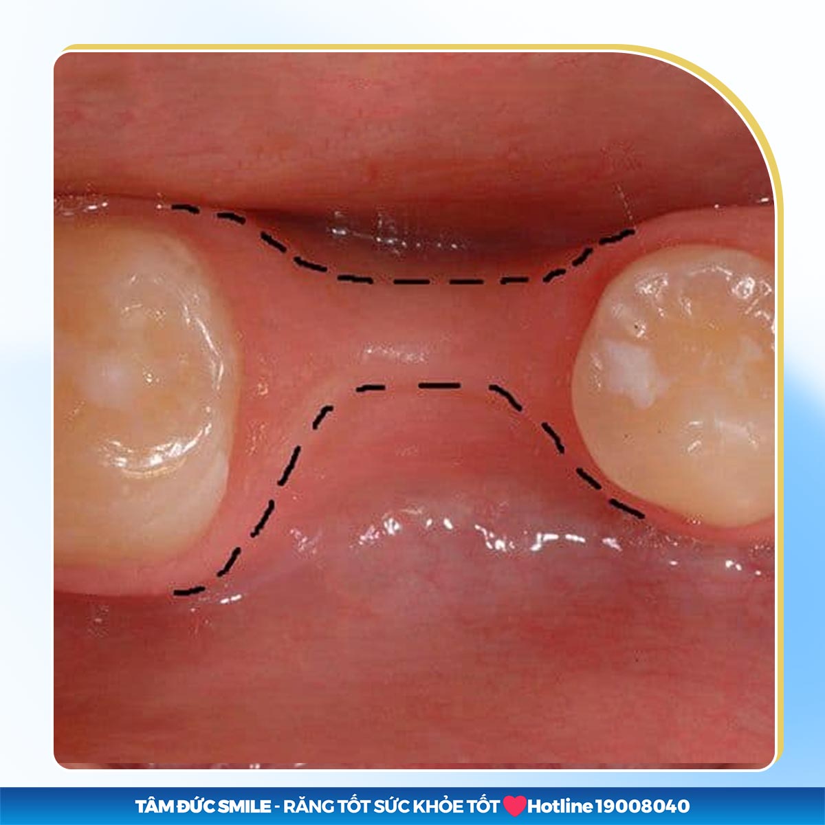 dấu hiệu bị tiêu xương hàm