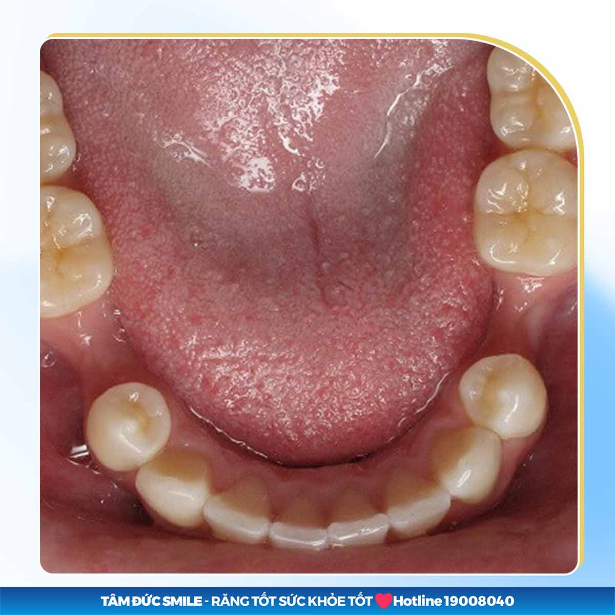 bị tiêu xương hàm có trồng răng được không