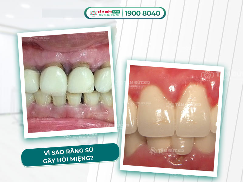 BỌC RĂNG SỨ BỊ HÔI MIỆNG, CHẢY MÁU CHÂN RĂNG, VÌ SAO?