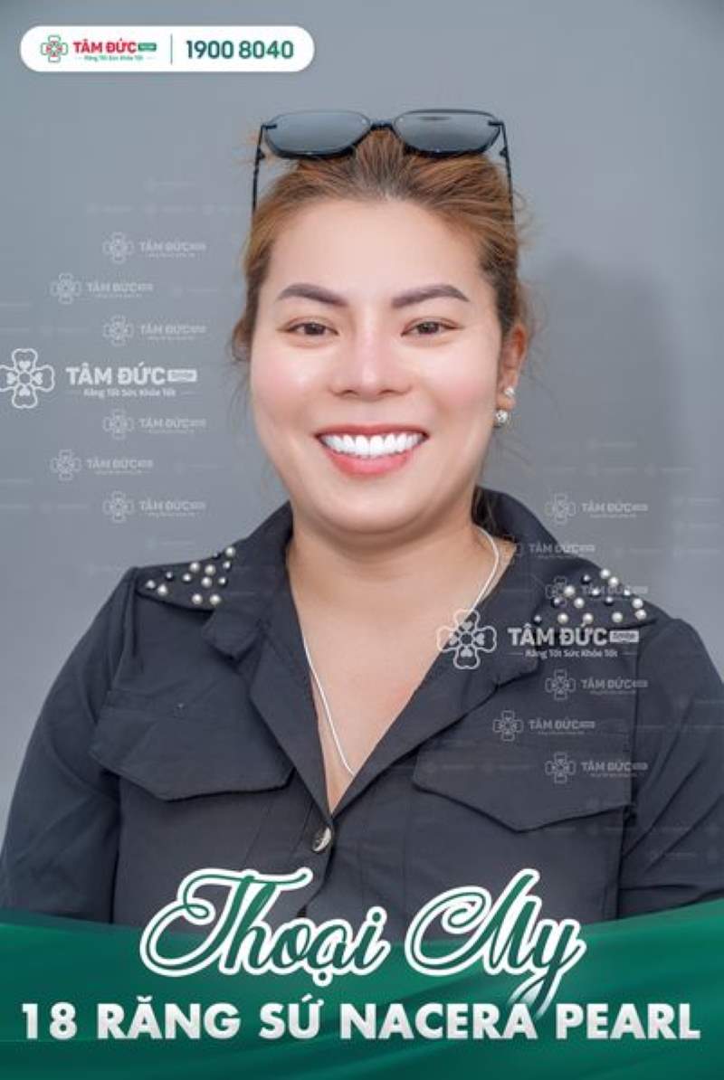 bọc răng sứ cho răng cửa