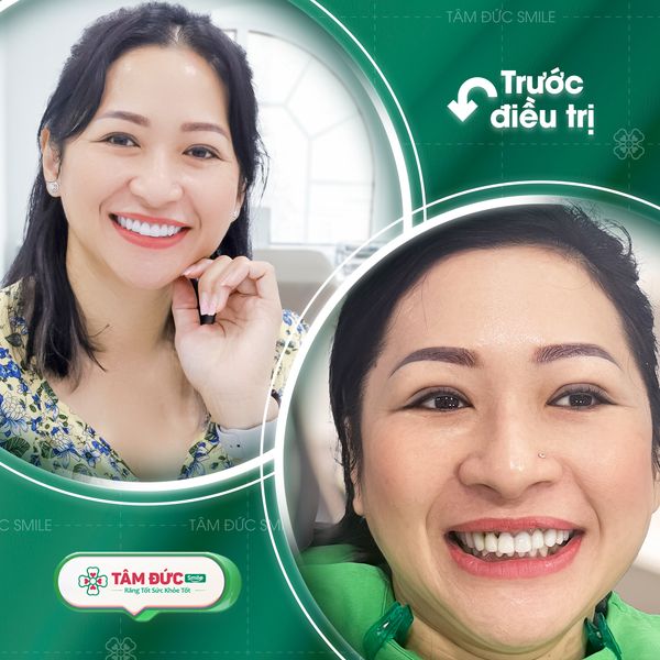 bọc răng sứ uống cà phê được không