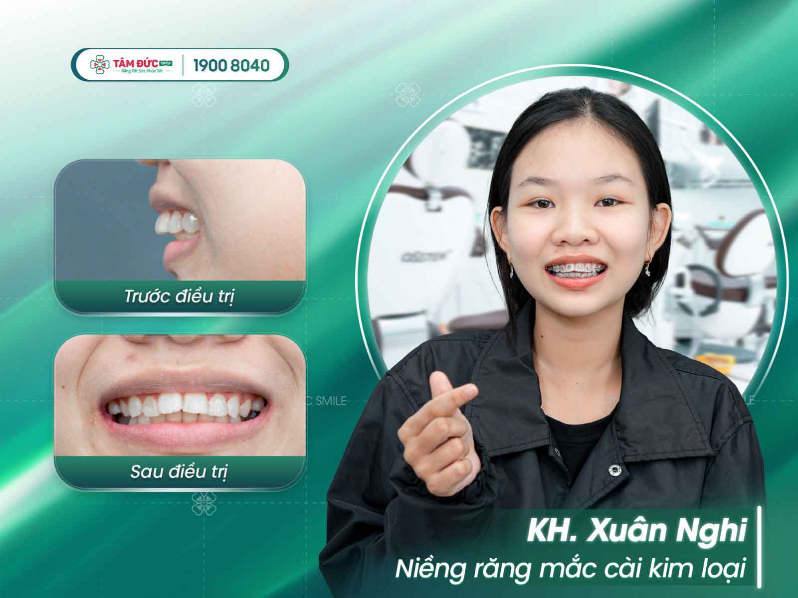 niềng răng mắc cài tự đóng tại nha khoa Tâm Đức Smile