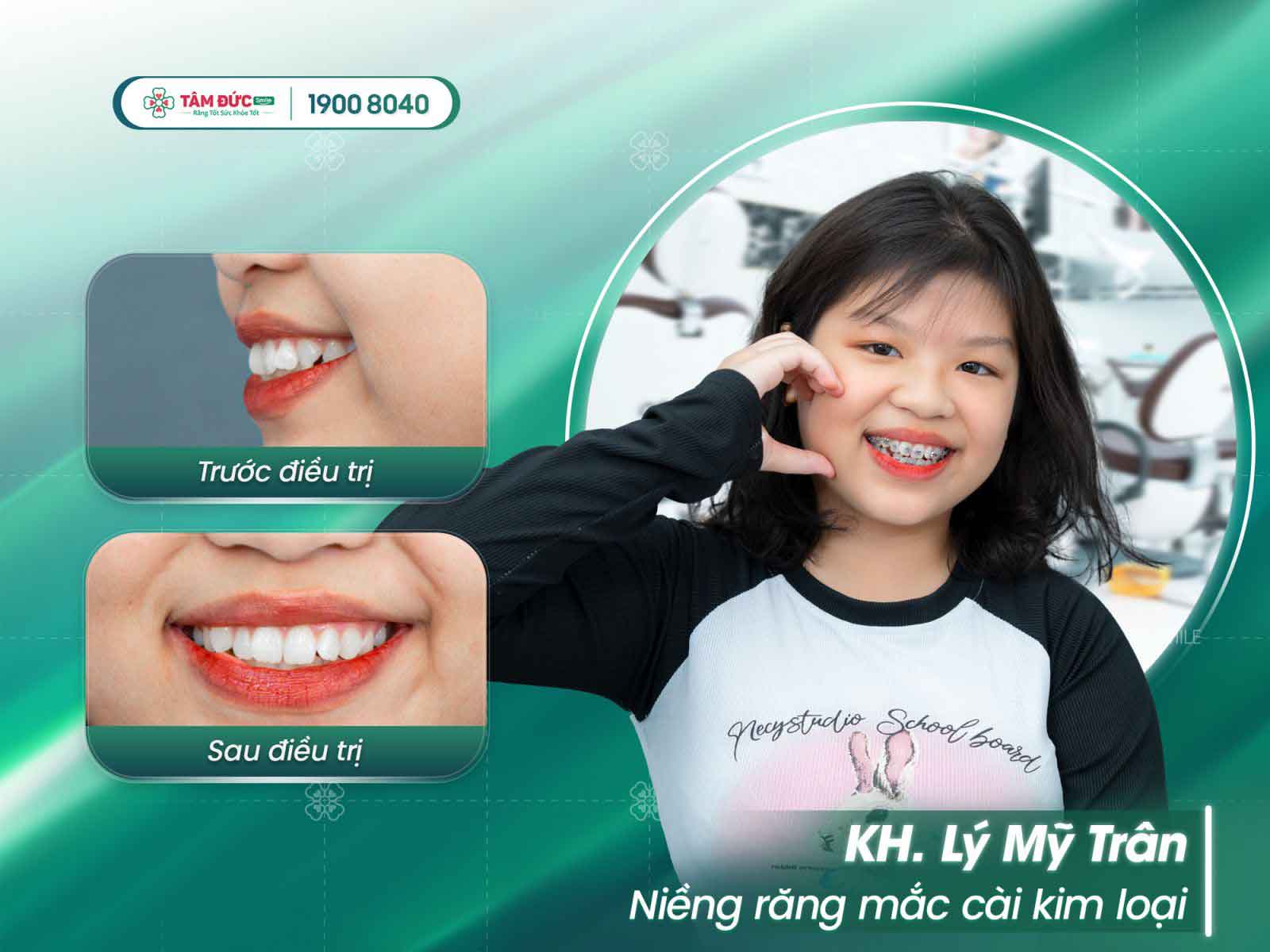 niềng răng mắc cài tự đóng