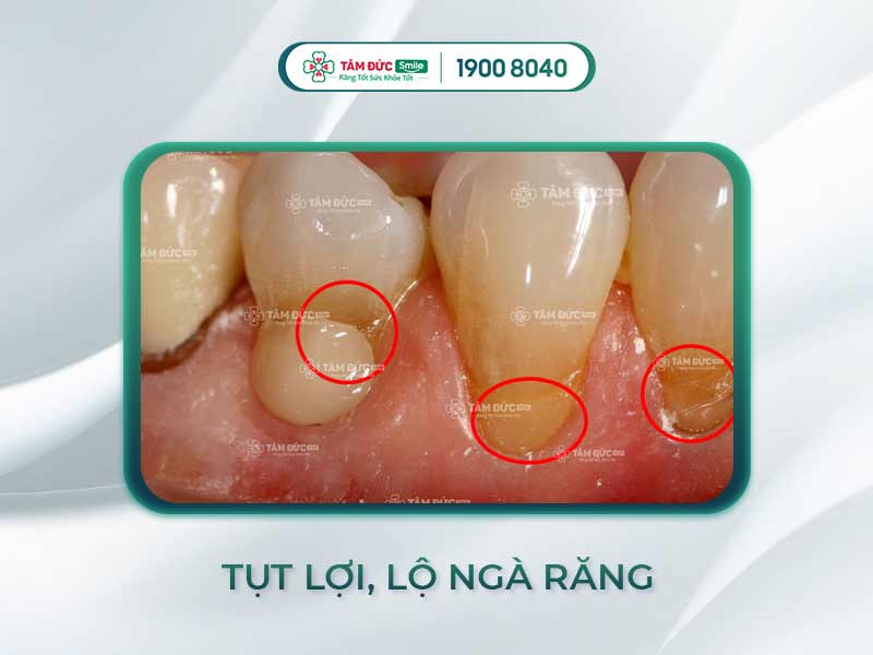 TOP 5 CÁCH CHỮA LỘ NGÀ RĂNG AN TOÀN, HIỆU QUẢ NHẤT 