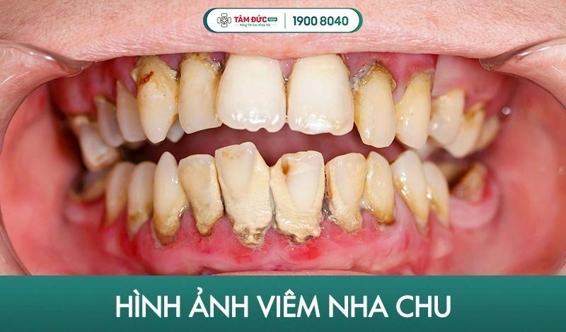 cách chữa viêm nha chu răng nặng