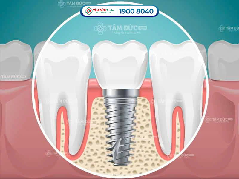 răng Implant ở trong khuôn hàm