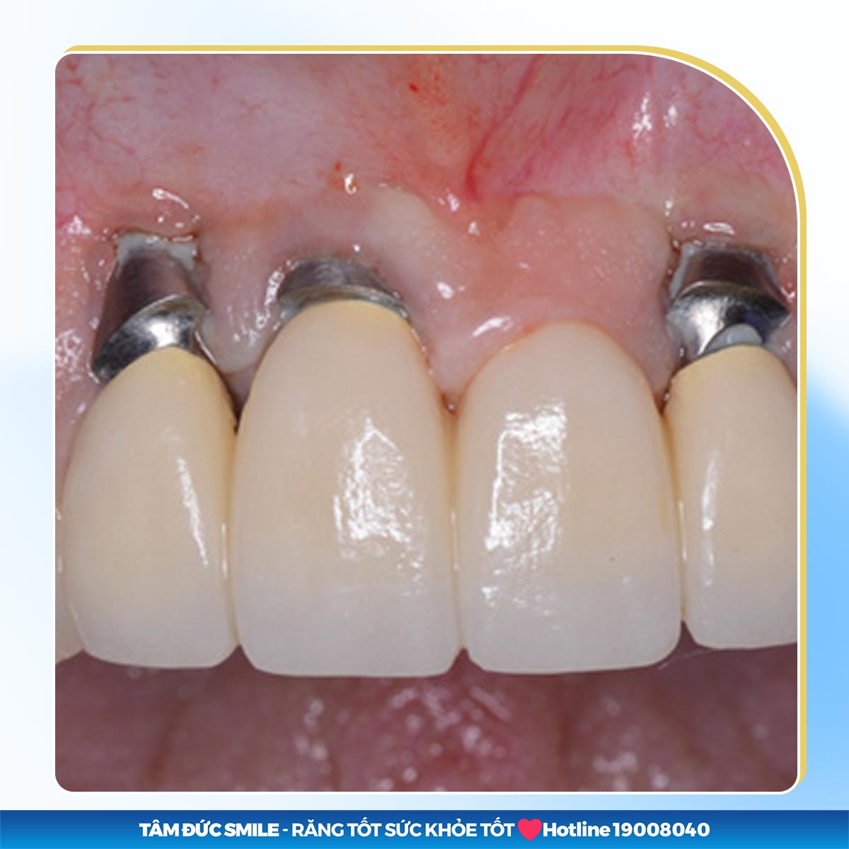 CẢNH BÁO IMPLANT GIÁ RẺ HỐI HẬN MỘT ĐỜI