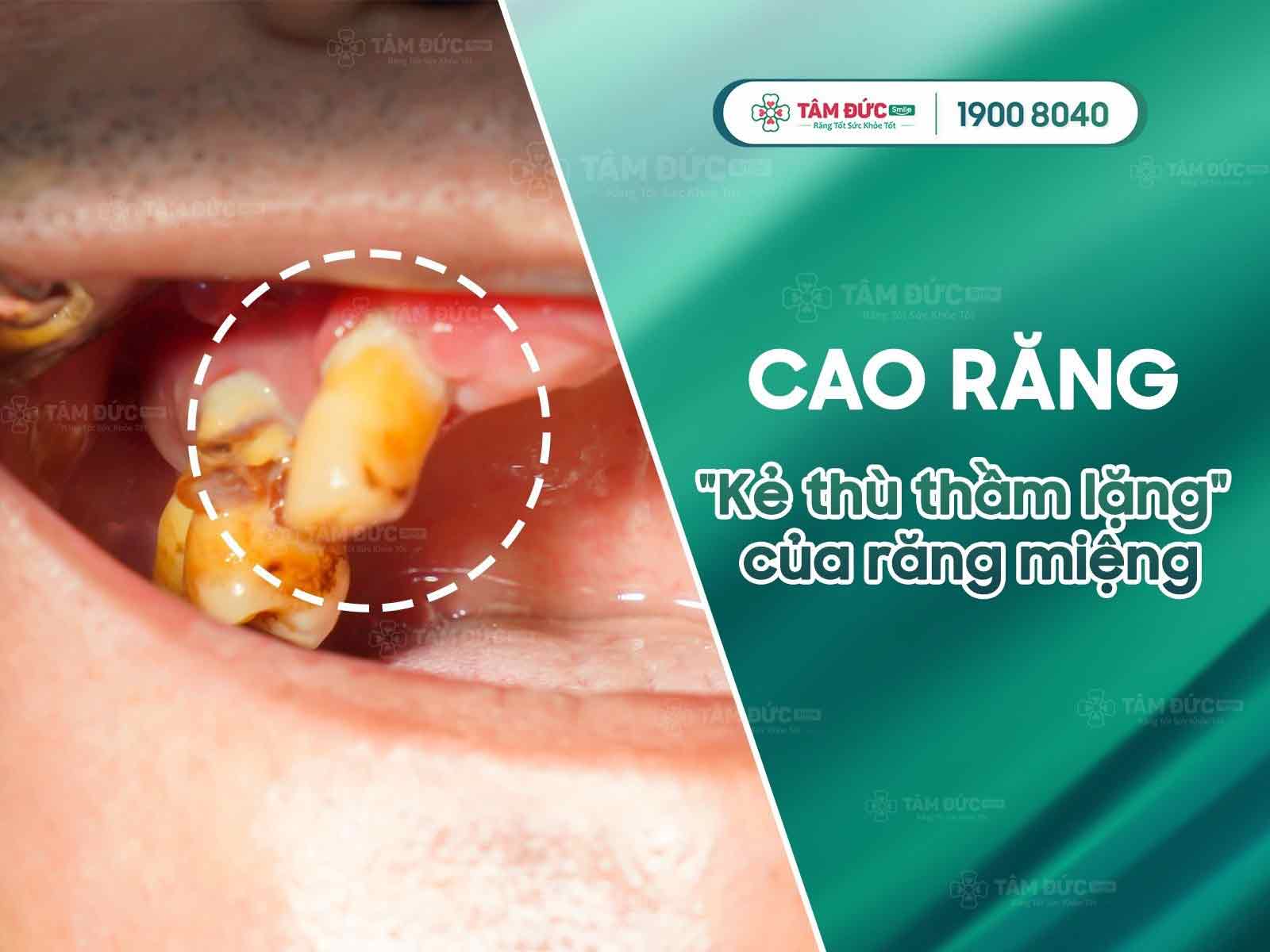 CAO RĂNG LÀ GÌ? 10 GIẢI ĐÁP QUAN TRỌNG VỀ CAO RĂNG VÀ VÔI RĂNG