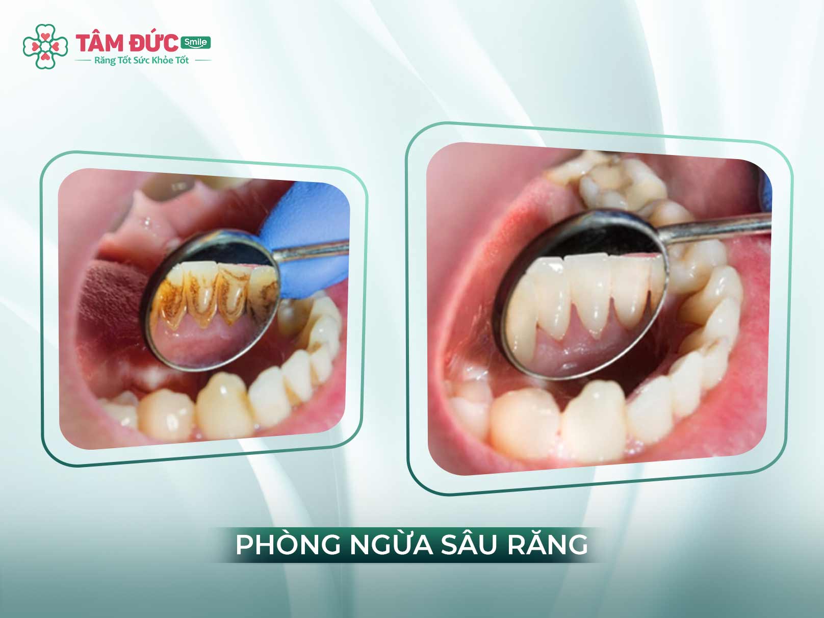 CẠO VÔI RĂNG LÀ GÌ? LỢI ÍCH CỦA CẠO VÔI RĂNG