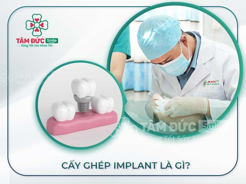 CẤY GHÉP IMPLANT LÀ GÌ? LỢI ÍCH KHI TRỒNG RĂNG IMPLANT