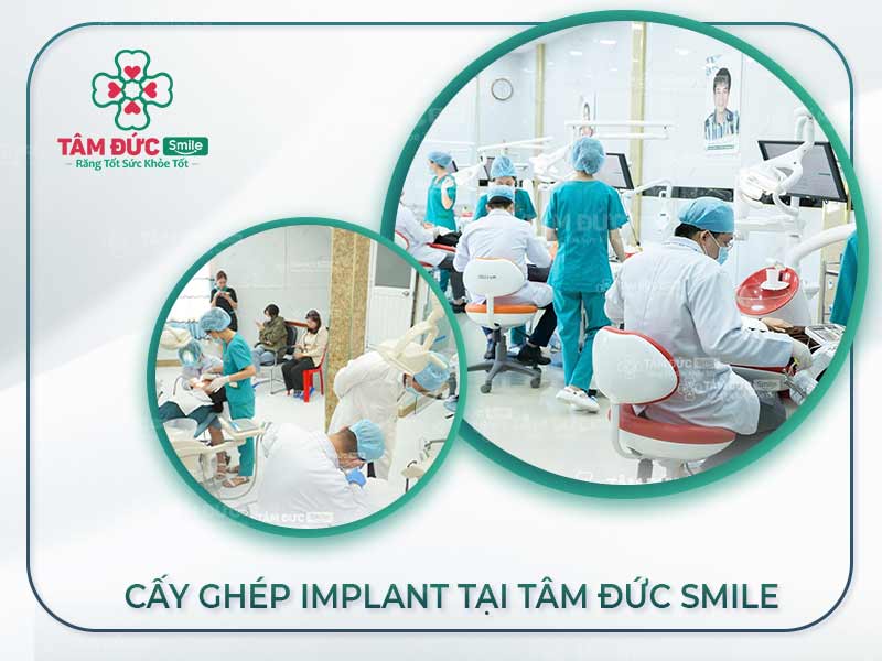  CẤY GHÉP IMPLANT Ở ĐÂU TỐT? DỰA VÀO TIÊU CHÍ NÀO ĐỂ LỰA CHỌN?