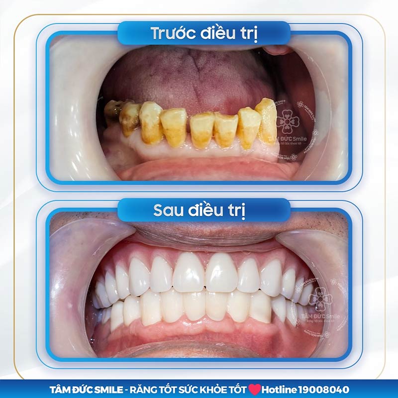 ưu điểm của trồng răng toàn hàm