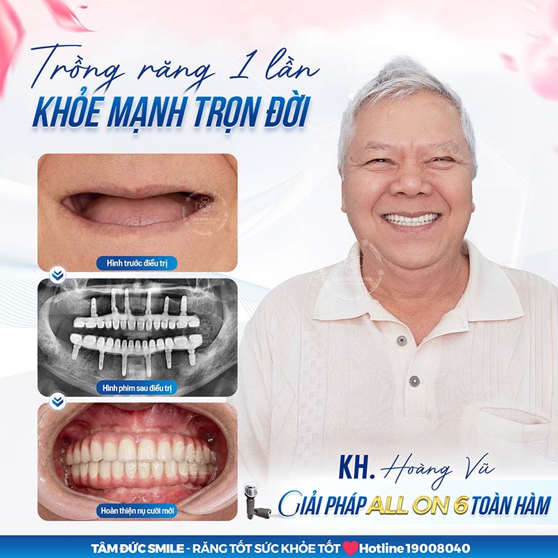 CẤY GHÉP IMPLANT TOÀN HÀM ALL ON 4 - 6 | GIẢI PHÁP PHÙ HỢP CHO NGƯỜI MẤT NHIỀU RĂNG