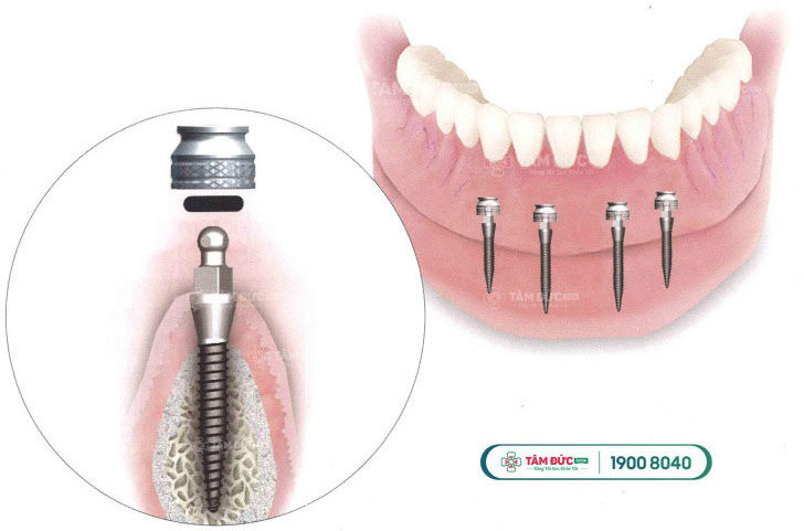   CẤY GHÉP MINI IMPLANT LÀ GÌ? ƯU ĐIỂM CỦA MINI IMPLANT
