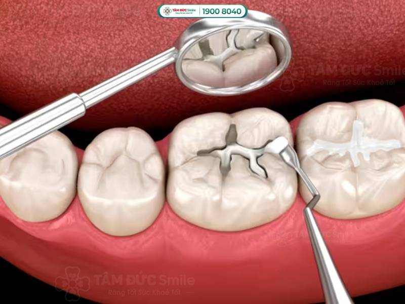 chân răng bị mòn có chữa được không