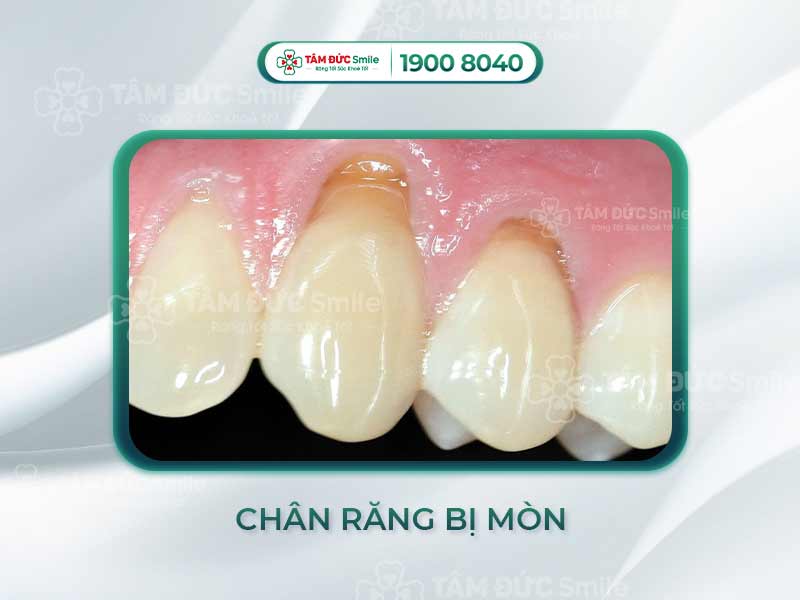 CHÂN RĂNG BỊ MÒN CÓ CHỮA ĐƯỢC KHÔNG? CÁCH KHẮC PHỤC HIỆU QUẢ