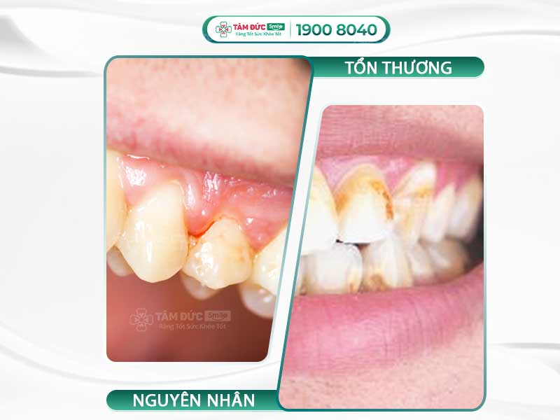 CHẢY MÁU CHÂN RĂNG VÀ BIỆN PHÁP CHỮA TRỊ DỨT ĐIỂM