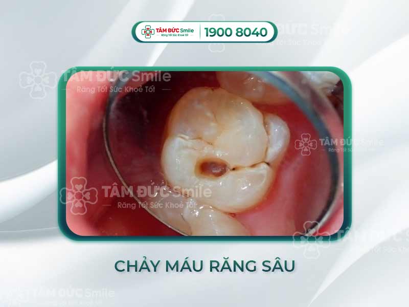 CHẢY MÁU RĂNG SÂU CÓ NGUY HIỂM KHÔNG? NGUYÊN NHÂN GÂY CHẢY MÁU RĂNG SÂU