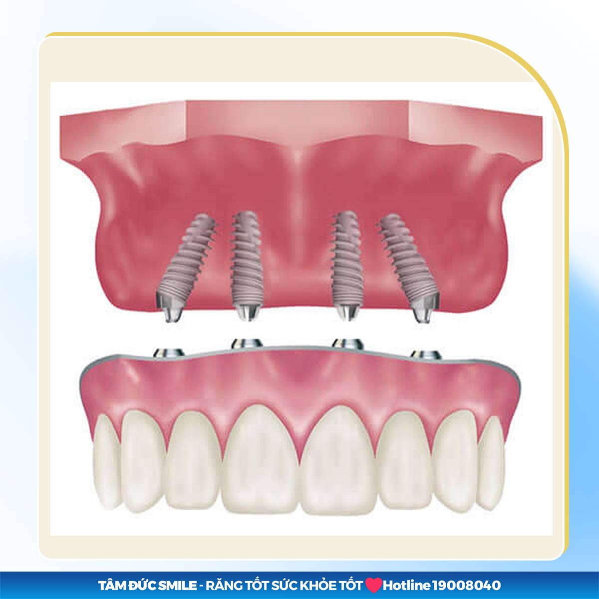 CHI PHÍ TRỒNG RĂNG IMPLANT ALL ON 4 GIÁ BAO NHIÊU TIỀN? BẢNG GIÁ MỚI NHẤT TẠI TÂM ĐỨC SMILE