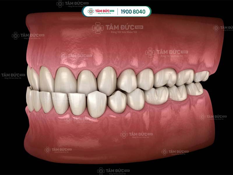 niềng răng hàm trên khi hàm trên móm