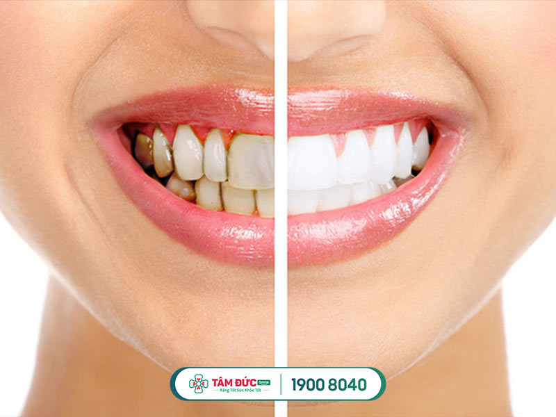 có nên tẩy trắng răng không