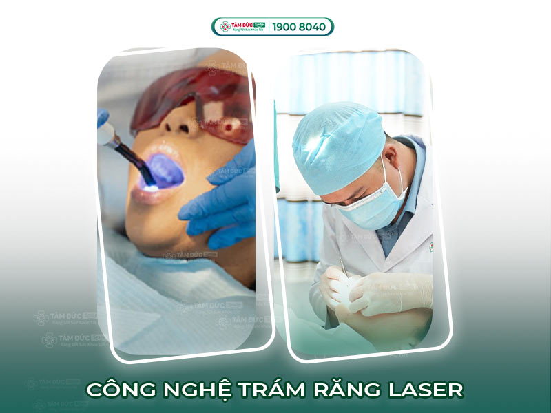 CÔNG NGHỆ TRÁM RĂNG LASER AN TOÀN VÀ HIỆU QUẢ 
