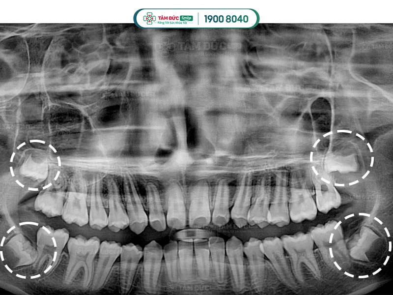 phim x-quang hàm răng