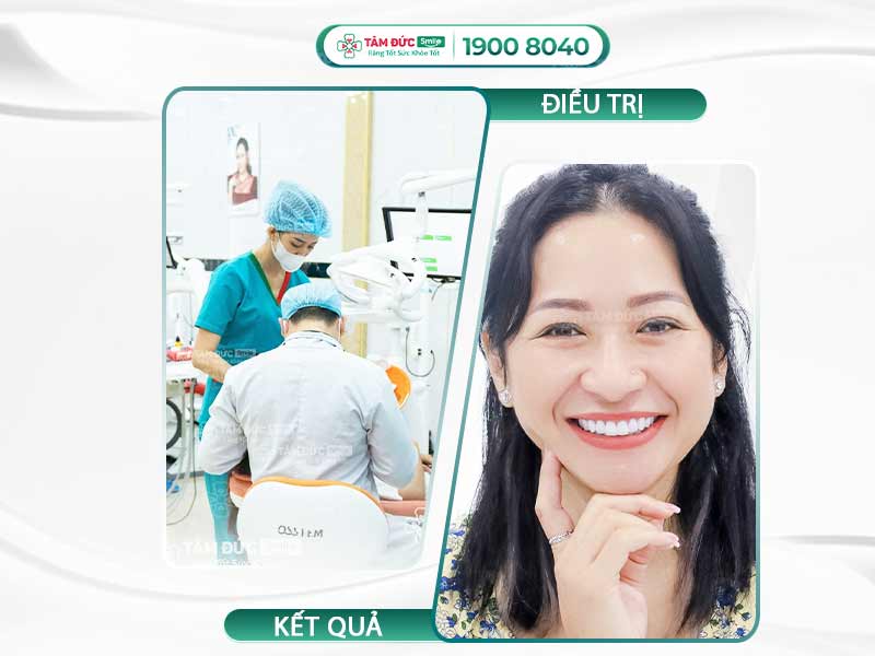 CẮT NẠO CHÓP RĂNG LÀ GÌ? ĐỊA CHỈ CẮT NẠO CHÓP RĂNG AN TOÀN UY TÍN
