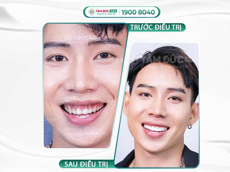 LÀM THẾ NÀO ĐỂ CHỮA TRỊ HỞ NƯỚU RĂNG HIỆU QUẢ?