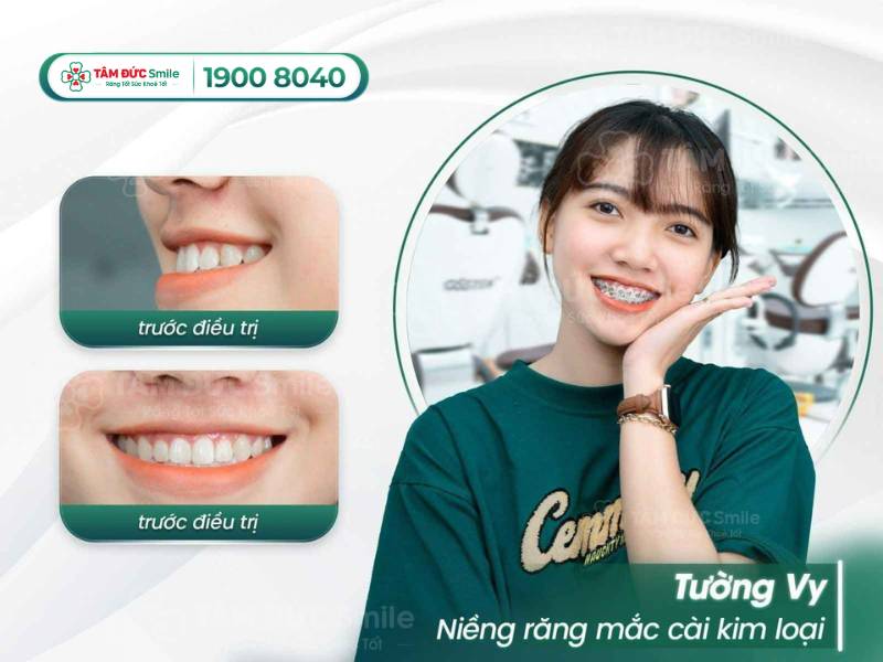 địa chỉ niềng răng ở Đà Nẵng uy tín