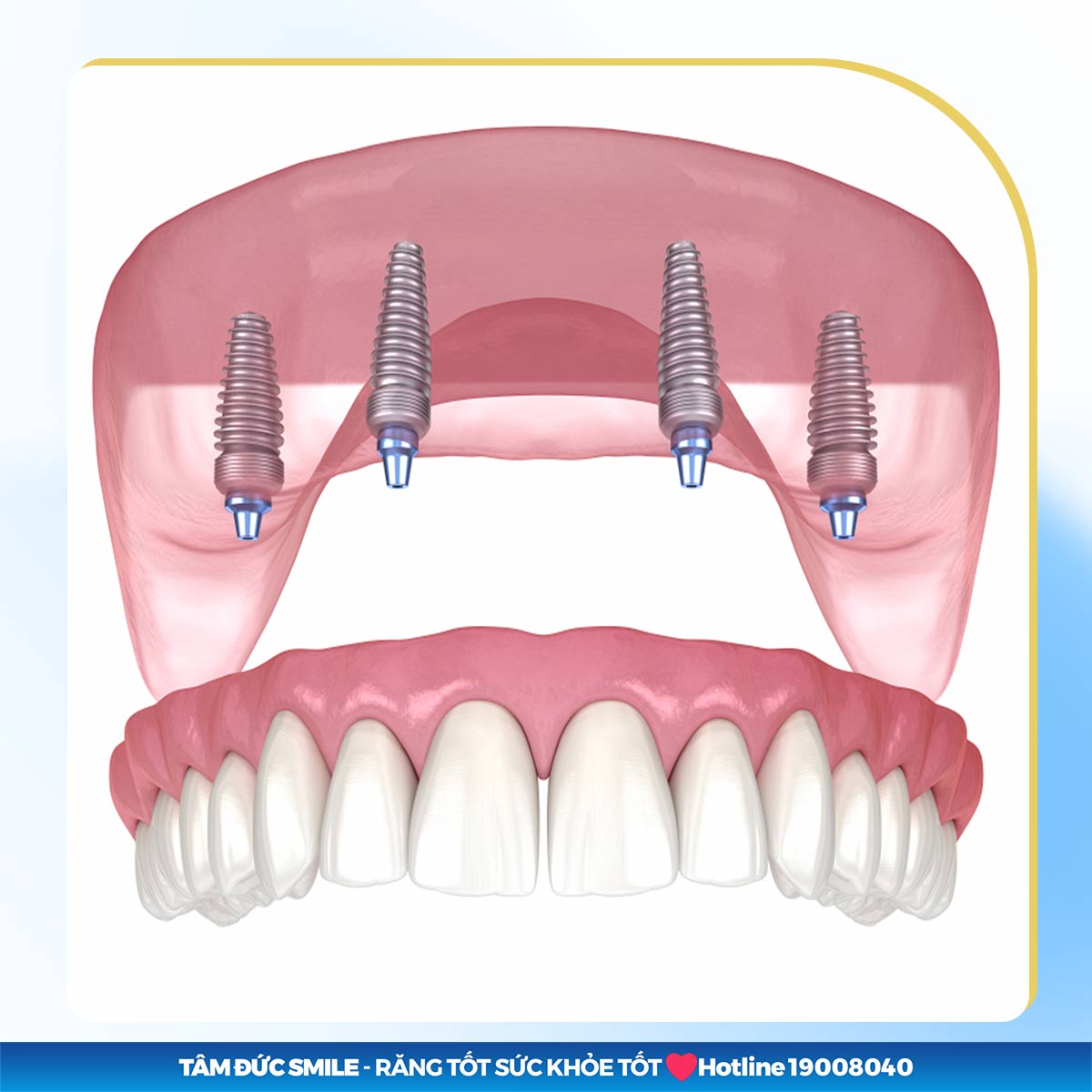 địa chỉ cấy ghép implant all on 4 uy tín tại tphcm