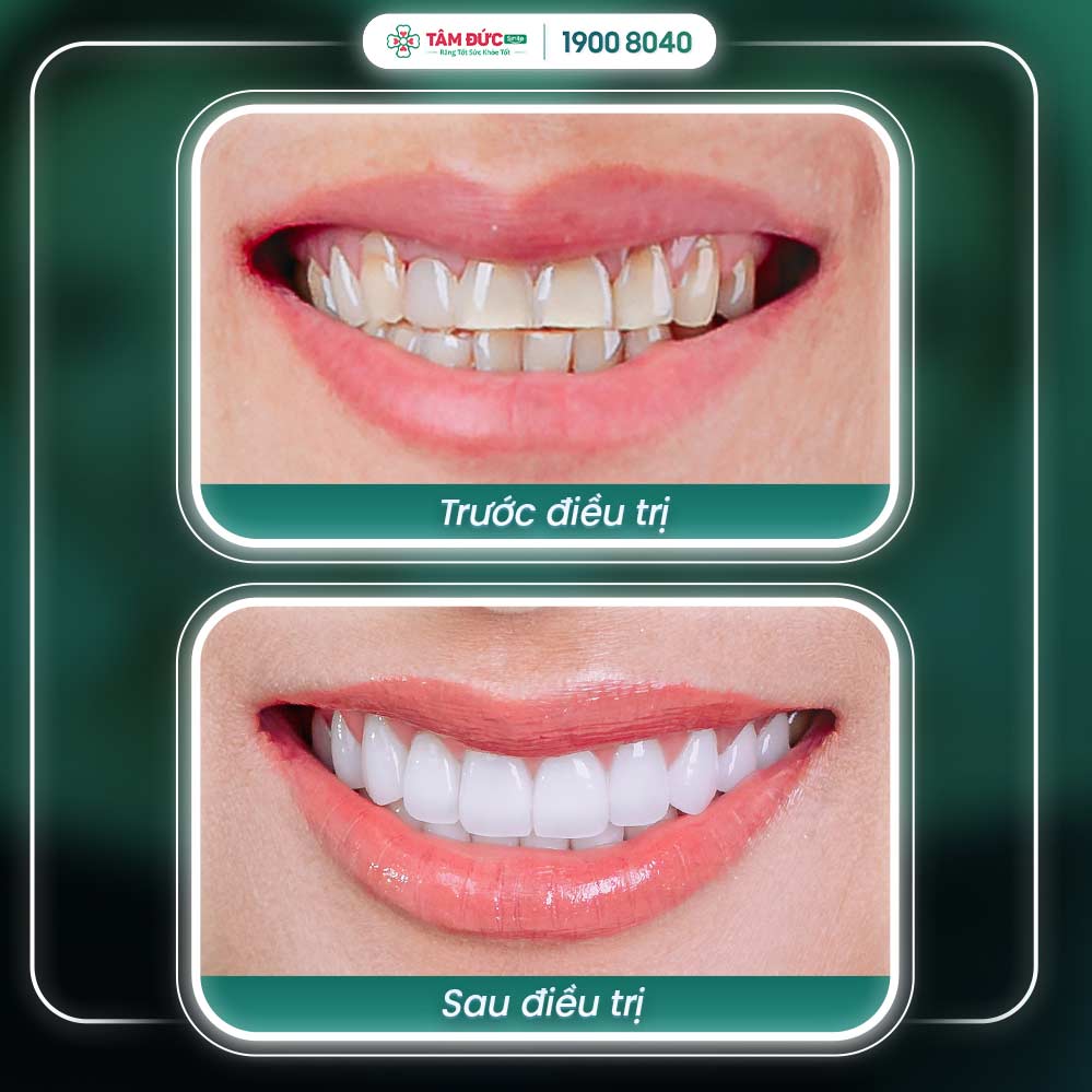 ảnh trước và sau khi điều trị răng nhạy cảm