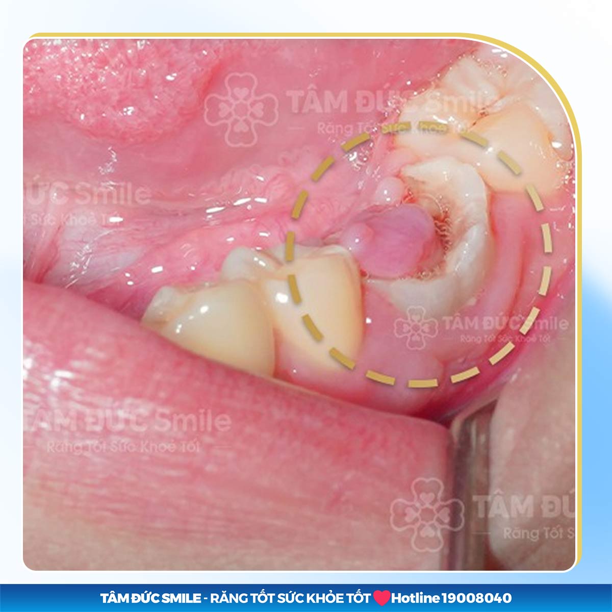 GÃY RĂNG HÀM CÓ SAO KHÔNG? CÁCH PHỤC HÌNH RĂNG HÀM HIỆU QUẢ