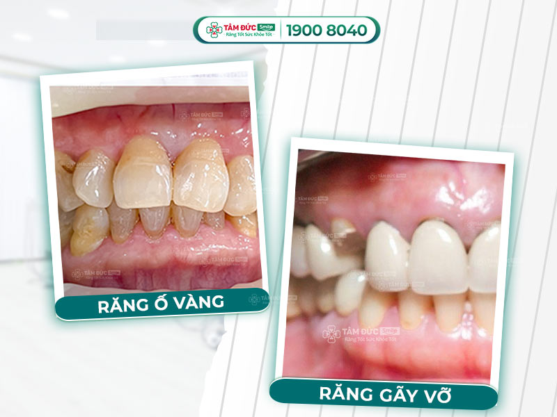 GIÁ BỌC RĂNG SỨ HÀM DƯỚI VÀ 5 TRƯỜNG HỢP NÊN BỌC RĂNG SỨ SỚM