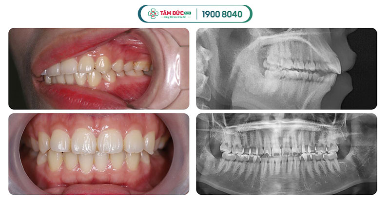 chi phí niềng răng hô tại nha khoa Tâm Đức Smile