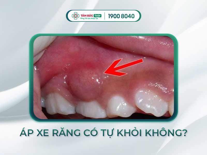 GIẢI ĐÁP: ÁP XE RĂNG CÓ TỰ KHỎI KHÔNG? TÁI LẠI CÓ NGUY HIỂM KHÔNG?