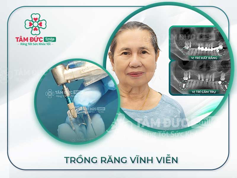 GIẢI PHÁP TRỒNG RĂNG GIẢ VĨNH VIỄN HIỆU QUẢ