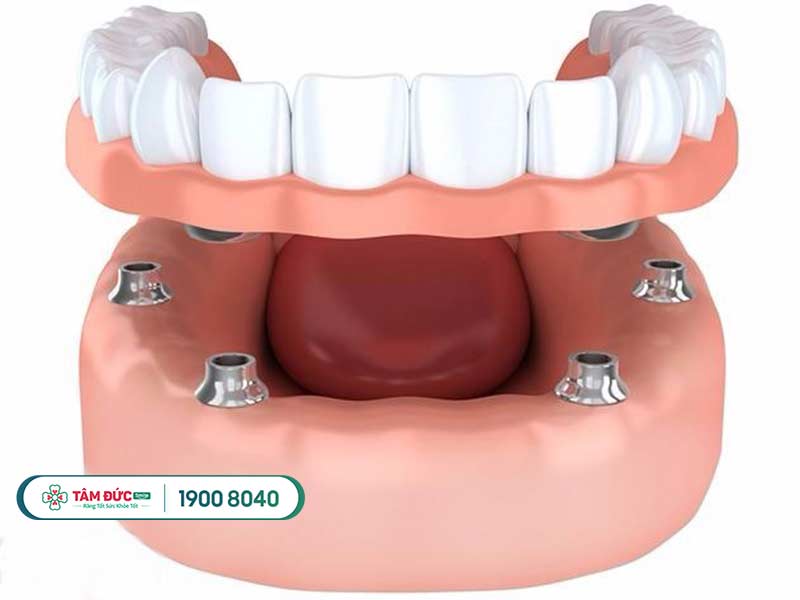 hàm giả tháo lắp có ưu điểm và nhược điểm gì