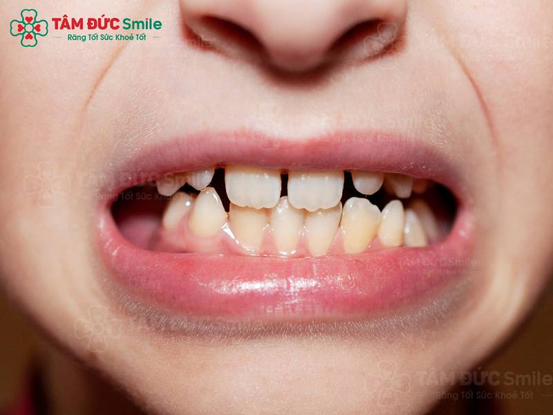 hàm răng người trưởng thành có bao nhiêu cái